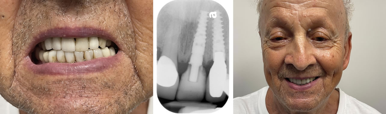 Broken Front Tooth Emergency Treatment AXIS DENTAL