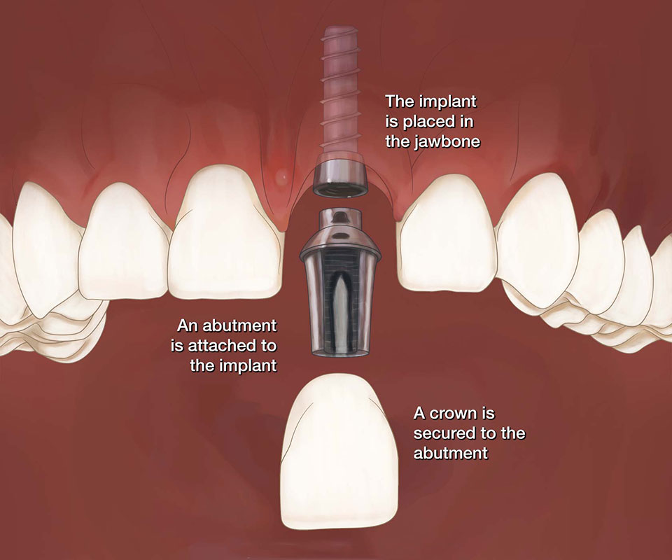 Broken Front Tooth Emergency Treatment AXIS DENTAL