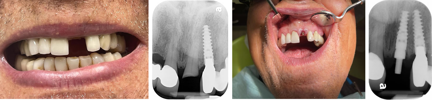 Broken Front Tooth Emergency Treatment AXIS DENTAL