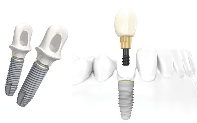 Broken Front Tooth Emergency Treatment AXIS DENTAL