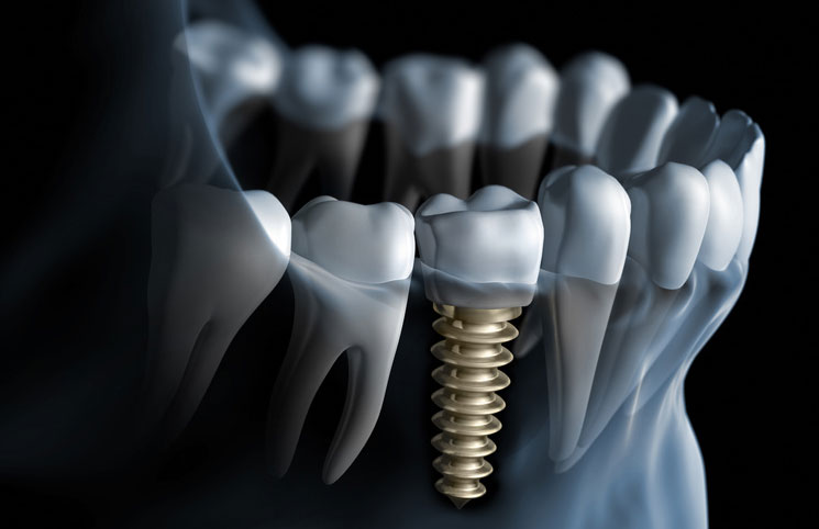 Dental Implants Brampton Ontario Canada