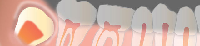 Wisdom Teeth Extractions