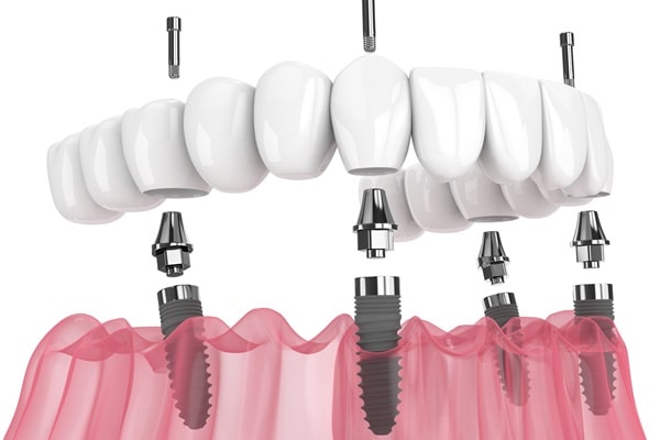 all-on-4-dental-implants