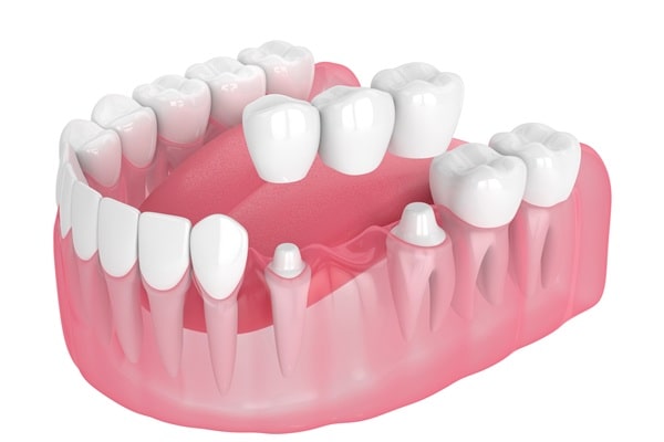 dental-crowns-bridges