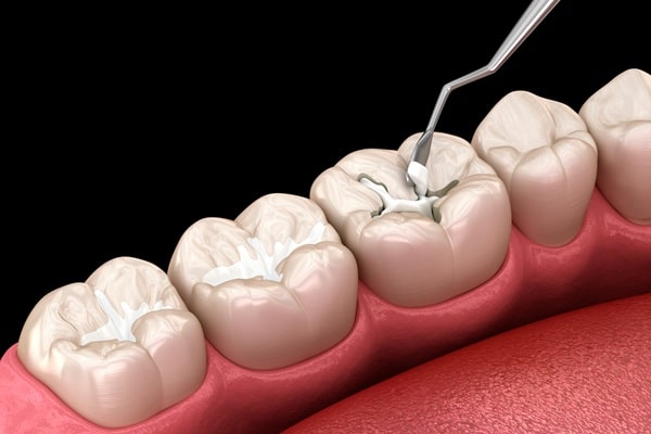 how-fluoride-treatment-works