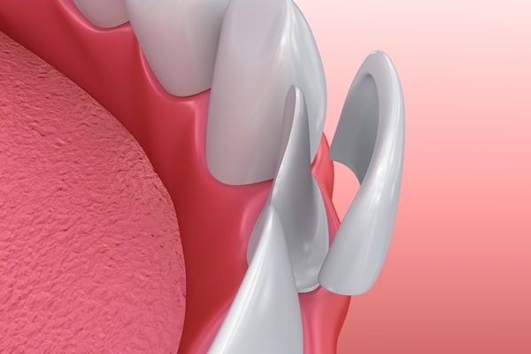 how-veneers-work-at-our-clinic