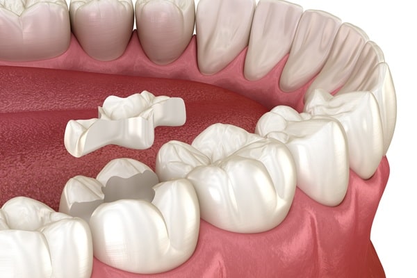 when-inlays-and-onlays-make-sense