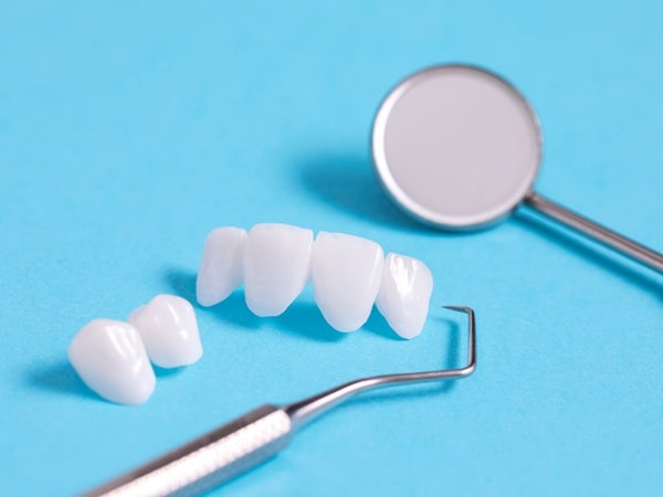 who-should-consider-veneers