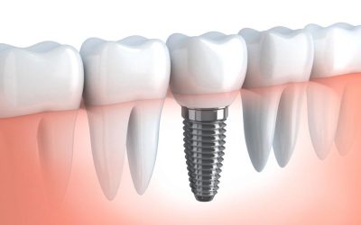 Dental Implants & Teeth in a Day!