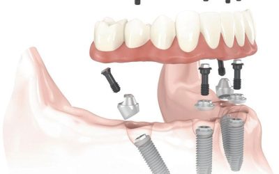The Facts About Dental Implants