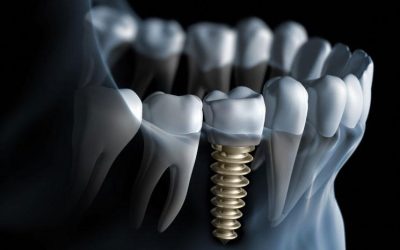 Today’s Better Alternative to Dentures – Dental Implants