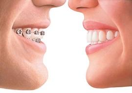 Invisalign – The Alternative to Metal Braces