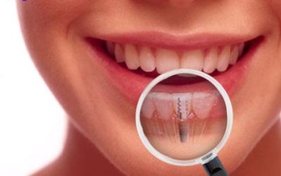 What Are Dental Implants and Why Should I Consider Them?