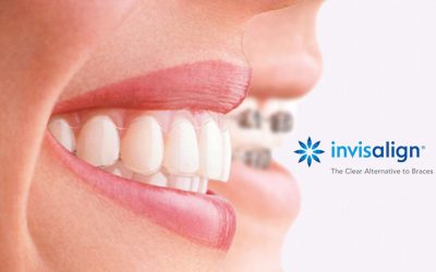 Traditional Metal Braces vs. Invisalign®