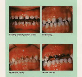 “All I want for Christmas is my two front teeth”…a new meaning…