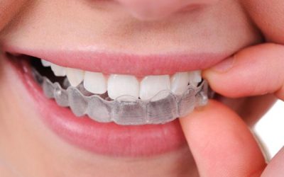 Teeth Straightening Options