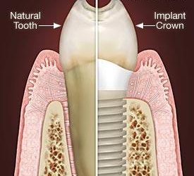 Am I a candidate for dental implants?