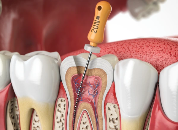 root-canals-brampton